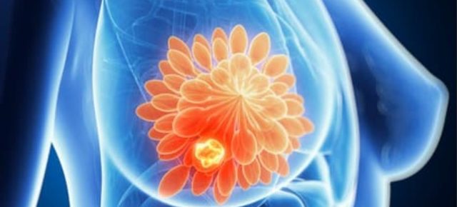 A preclinical study suggests another possibility in the treatment of breast cancer