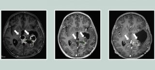 Viitorul AI în cancer: În 10 secunde, un model inteligent poate detecta o tumoră cerebrală canceroasă, adesea omisă în timpul operaţiilor
