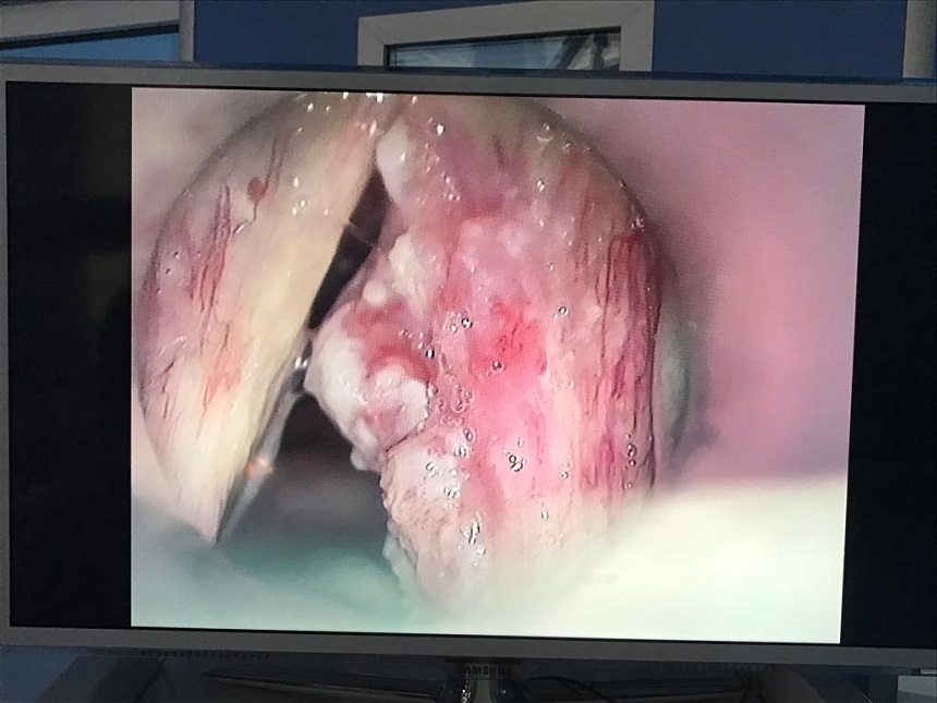 AI ar putea detecta semnele timpurii ale cancerului de laringe doar analizând vocea pacienţilor 