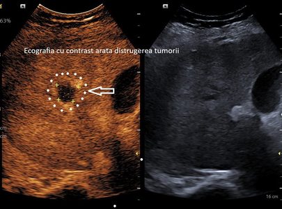 Spitalul Clinic Judeţean de Urgenţă Craiova anunţă realizarea primei ablaţii cu microunde a unei tumori hepatice / La doar o lună după intervenţie, investigaţiile imagistice au confirmat distrugerea completă a tumorii

