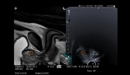 Spitalul Judetean de Urgenţă Satu Mare anunţă introducerea şi extinderea biopsiilor prostatice prin tehnica RMN-fusion