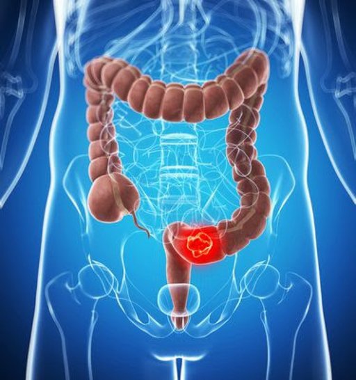 Un virus nou descoperit în intestin, asociat cu cancerul colorectal

