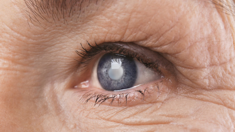 Eurostat: Cea mai frecventă procedură chirurgicală efectuată în spitalele din UE în 2023 a fost operaţia de cataractă / România, cea mai mică rată la 100.000 de locuitori /  Peste un milion de cezariene în UE, cele mai multe în Cipru şi România

 