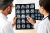Un nou instrument de AI pentru îmbunătăţirea diagnosticului, dezvoltat de cercetători pe fondul creşterii numărului cazurilor de demenţă