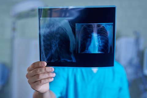 Mai devreme înseamnă mai multe şanse: importanţa depistării precoce în cancerul pulmonar