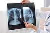 O nouă combinaţie de imunoterapie a prelungit supravieţuirea într-una dintre cele mai agresive forme de cancer pulmonar. Rezultate pozitive într-un studiu de fază III