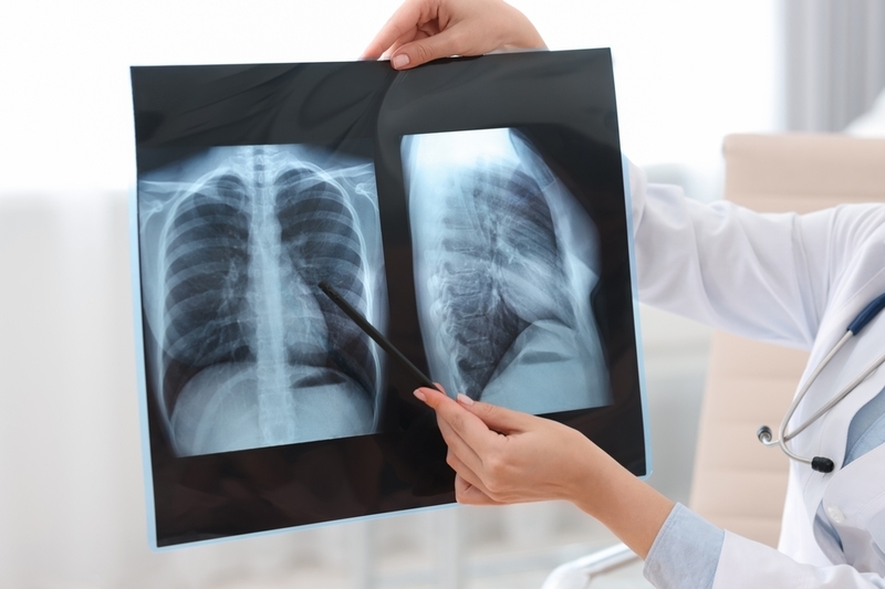 O nouă combinaţie de imunoterapie a prelungit supravieţuirea într-una dintre cele mai agresive forme de cancer pulmonar. Rezultate pozitive într-un studiu de fază III