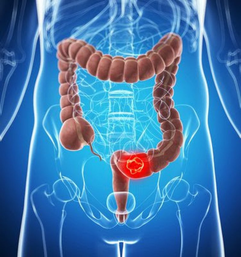 Apendicectomia pentru apendicită acută, asociată cu un risc mai mic de cancer colorectal într-un studiu cu peste 30.000 de pacienți