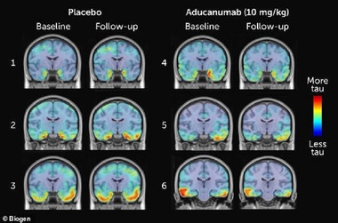 Biogen este pe cale să obţină autorizarea unui medicament experimental pentru Alzheimer; Acţiunile Biogen au urcat cu 40%