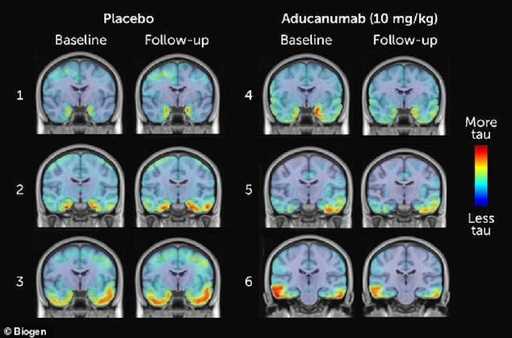 Biogen este pe cale să obţină autorizarea unui medicament experimental pentru Alzheimer; Acţiunile Biogen au urcat cu 40%