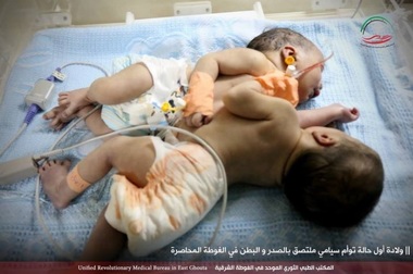 O pereche de gemeni siamezi s-au născut într-o provincie siriană cuprinsă de război
