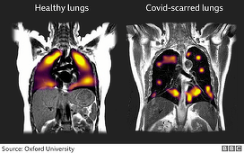 Covid-19 cauzează leziuni pulmonare, observate la mai multe luni de la îmbolnăvire, arată un studiu al Universităţii Oxford, care pregăteşte un nou studiu pentru a verifica dacă pacienţi nespitalizaţi şi fără simptome grave au aceleaşi probleme