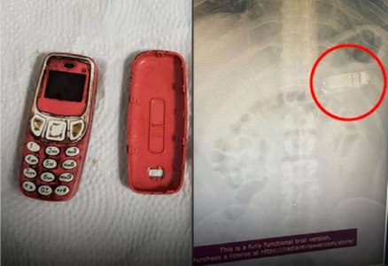 Un medic kosovar scoate un telefon marca Nokia 3310 din stomacul unui deţinut