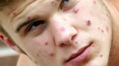 ONUSIDA avertizează împotriva homofobiei şi rasismului în legătură cu ”monkeypox”, variola maimuţei