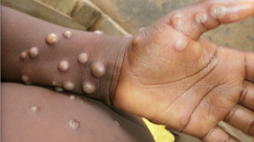 Emiratele Arabe Unite, Republica Cehă şi Slovenia au înregistrat primele cazuri de variola maimuţei