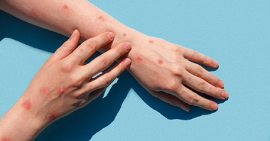 Un italian în vârstă de 36 de ani este prima persoană din lume testată pozitiv pentru variola maimuţei, Covid şi HIV în acelaşi timp