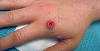 Variola maimuţei va fi redenumită mpox pentru a evita driscriminarea şi stigmatizarea, anunţă Organizaţia Mondială a Sănătăţii