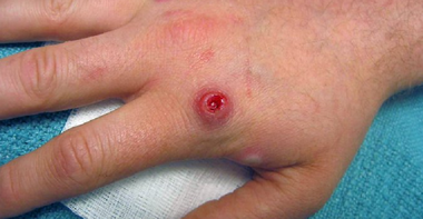 Variola maimuţei va fi redenumită mpox pentru a evita driscriminarea şi stigmatizarea, anunţă Organizaţia Mondială a Sănătăţii