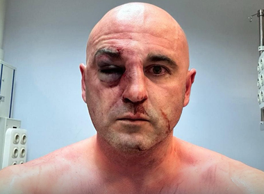 Un deputat georgian, Levan Habeişvili, îşi arată nasul spart şi ochiul vânăt în Parlament. ”Rusia este ceea ce vedeţi acum pe corpul meu, iar din nefericire prea mulţi copii s-au trezit aşa”. Zeci de mii de manifestanţi împotriva proiectului legii ”influenţei străine”