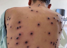 UPDATE-OMS declanşează cel mai înalt nivel de alertă sanitară la nivel internaţional împotriva unei creşteri a cazurilor de mpox în Africa. ”Ne confruntăm cu mai multe epidemii diferite de clade în diverse ţări, cu moduri de transmitere diferite şi nivelu