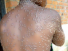 Pakistanul declară un prim caz de mpox, a unei persoane care venea dintr-o ţară de la Golful Persic