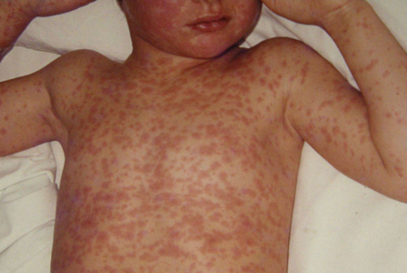Un prim copil, nevaccinat, moare de rujeolă în SUA, într-o epidemie în Texas. Peste 120 de cazuri în Texas, zece în New Mexico. Majoritatea într-un comitat cu populaţie larg maronită, o comunitatea religioasă ultraconservatoare