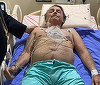 Fostul preşedinte al Braziliei, Jair Bolsonaro, ar putea avea nevoie de o nouă intervenţie chirurgicală după internarea în spital
