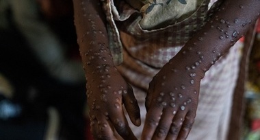 Un prim deces din cauza mpox, înregistrat în epidemia din Ghana