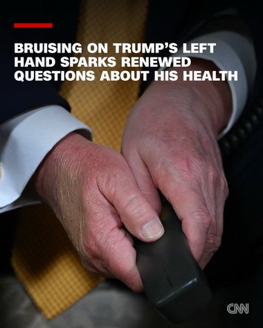 CNN: Trump a apărut din nou cu vânătăi, de data aceasta pe mâna stângă, relansând întrebările despre starea sa de sănătate