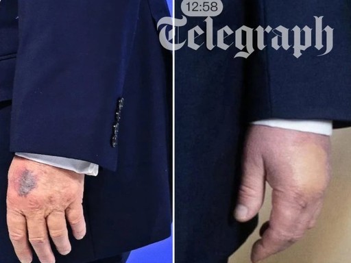 Donald Trump a fost observat la Davos, din nou, cu o vânătaie pe mâna stângă. Explicaţia Casei Albe: s-a lovit de colţul mesei în timpul ceremoniei de semnare a Consiliului Păcii