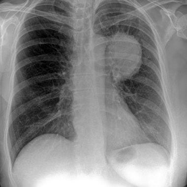 STUDIU - Răspândirea cancerului în organism, redusă cu 75% în cadrul unor teste pe animale