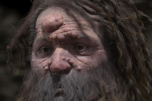 Omul de Cro-Magnon avea un chip acoperit de noduli benigni - studiu
