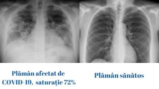 Caz medical rar: pacient menţinut în viaţă fără plămâni timp de 48 de ore până la transplant
