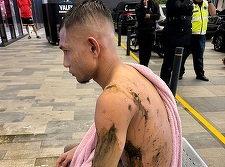 Fotbalistul malaysian stropit cu acid, în stare din ce în ce mai bună după o grefă de piele