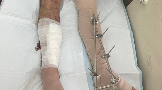 Război în Ucraina: Un campion la înot, grav rănit la picioare pe front