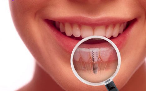 COMUNICAT DE PRESĂ: Fast&fixed, cele mai rapide implanturi dentare de la Dr. Leahu