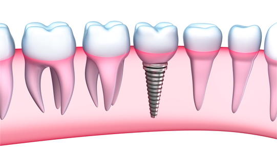 COMUNICAT DE PRESĂ: De Sarbători, fă-ti cadou implanturi dentare rapide de la dr. Leahu