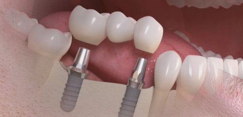 COMUNICAT DE PRESĂ: 10 lucruri pe care trebuie sa le stii despre implantul dentar