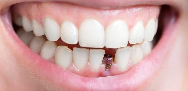 Principalele şapte motive pentru căderea dinţilor şi cum se rezolvă aceste probleme cu ajutorul unui implant dentar?