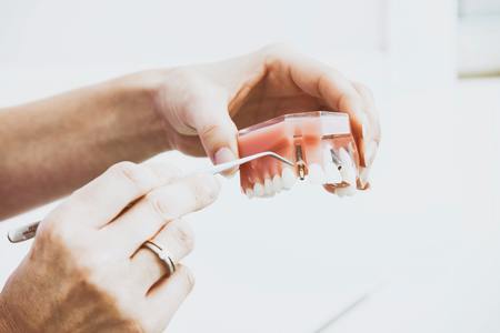 COMUNICAT DE PRESĂ: Lecţia de stomatologie: Cum îngrijim corect un implant dentar?