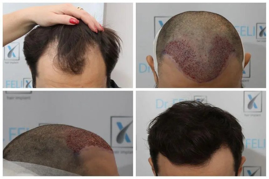 COMUNICAT DE PRESĂ: Implant de păr prin tehnica Q-FUE manual: soluţia la Dr. Felix Hair Implant