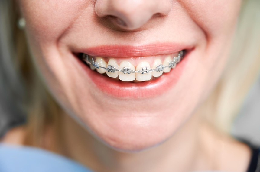 COMUNICAT DE PRESĂ: 5 lucruri pe care ar trebui să le ştii după ce îţi pui aparat dentar