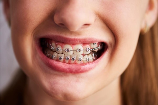 COMUNICAT DE PRESĂ: Tips and tricks pentru cei care au aparat dentar