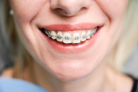 COMUNICAT DE PRESĂ: Îndreptarea dinţilor cu aparat dentar. Ce trebuie să ştii înainte şi după tratament