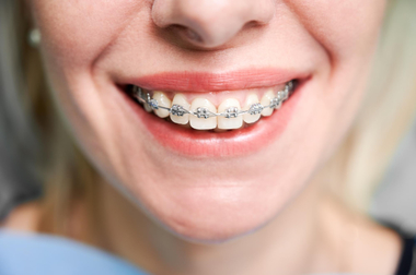 COMUNICAT DE PRESĂ: Îndreptarea dinţilor cu aparat dentar. Ce trebuie să ştii înainte şi după tratament