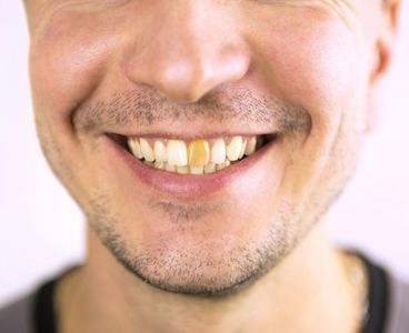 COMUNICAT DE PRESĂ: Soluţii eficiente pentru dinţii ciobiţi