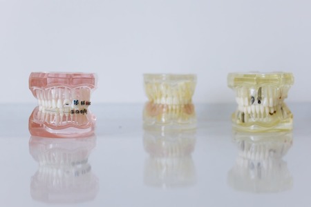 Implant dentar sau proteză dentară? Diferenţe şi comparaţii