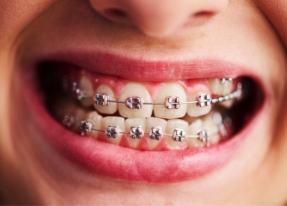 3 greşeli frecvente ale pacienţilor cu aparat dentar şi cum le poţi evita