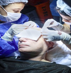 Transplant de păr în Turcia cu tehnica Vita (P)