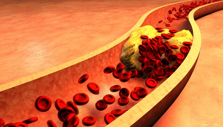 Studiu: Un nivel moderat al ”colesterolului rău” poate provoca decesul prematur al unor adulţi sănătoşi